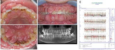 Er,Cr:YSGG Laser Therapy for Drug-Induced Gingival Overgrowth: A Report of Two Case Series